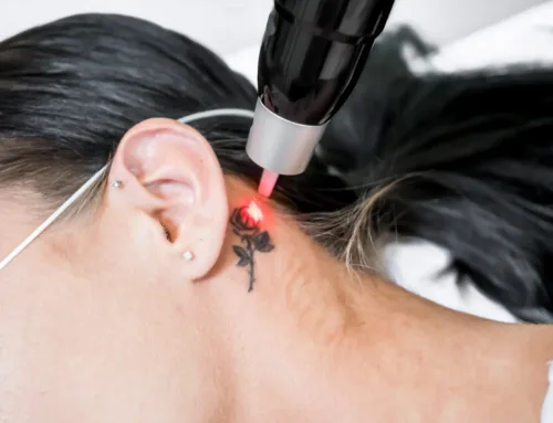 What To Do When You Want to Remove a Tattoo